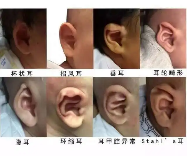 小耳畸形患儿几岁接受耳再造手术最佳？广药附一余文林主任专业解答
