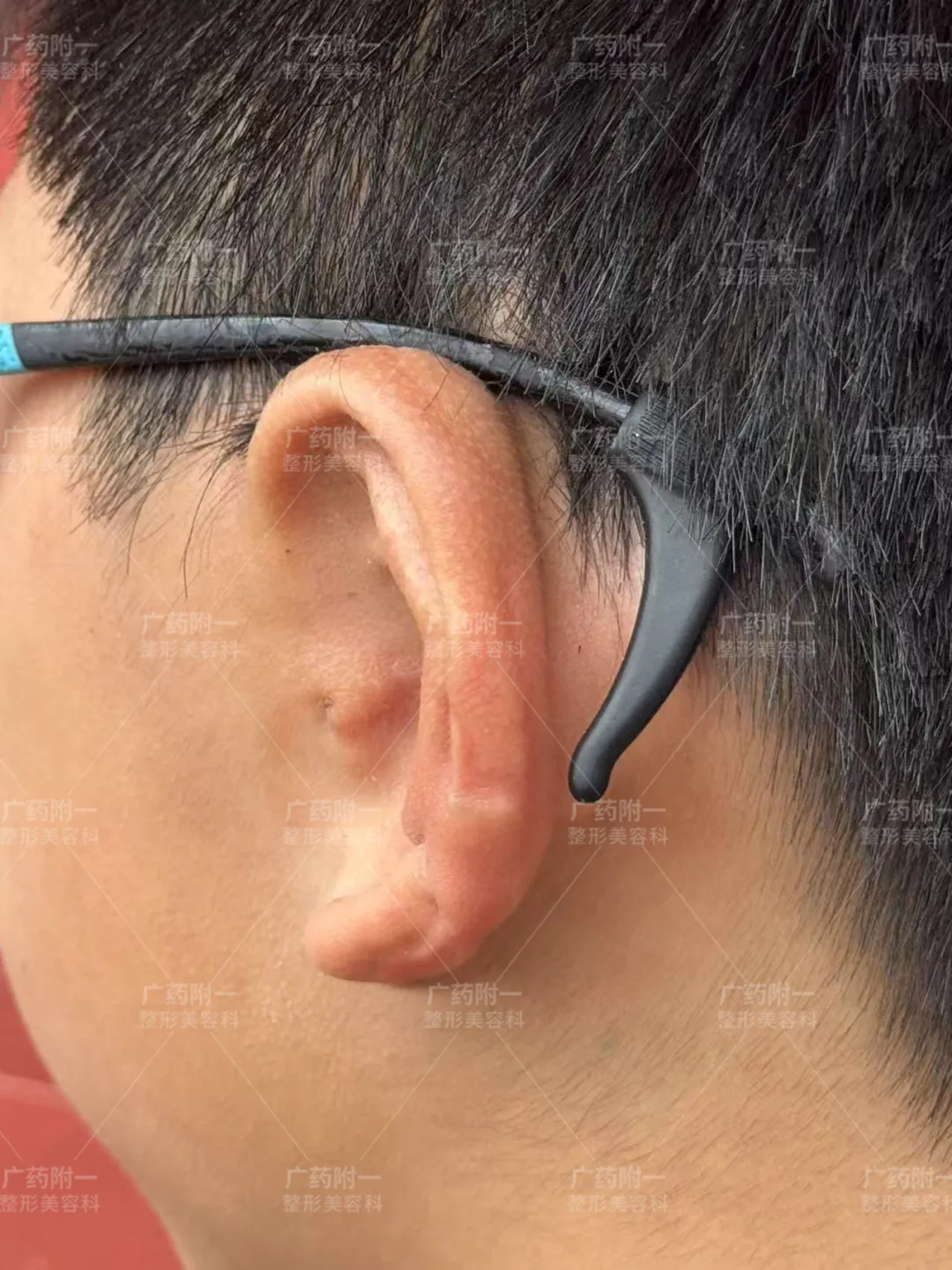 小耳畸形患儿几岁接受耳再造手术最佳？广药附一余文林主任专业解答