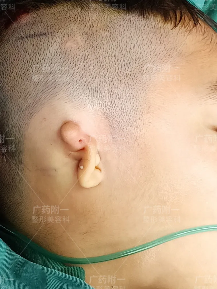 小耳畸形患儿几岁接受耳再造手术最佳？广药附一余文林主任专业解答