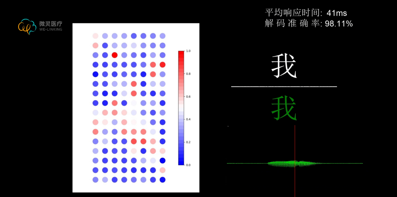 华南首秀！微灵医疗发布高密度薄膜电极术中唤醒与解码研究成果